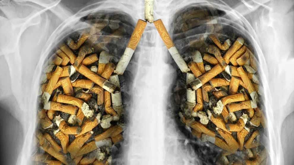 Skrining tahunan menggunakan Low Dose CT Scan (LDCT) direkomendasikan bagi orang berusia 50–80 tahun yang memiliki riwayat merokok sedikitnya 20 pack-year (rokok yang dihisap). Foto: newsnetwork.mayoclinic.org